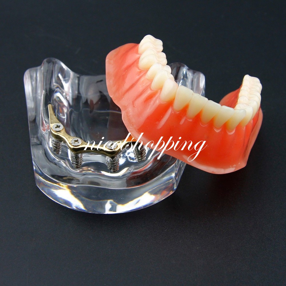Dental Inferior Overdenture Model Lower Precision Implants With Silver Bar #6009