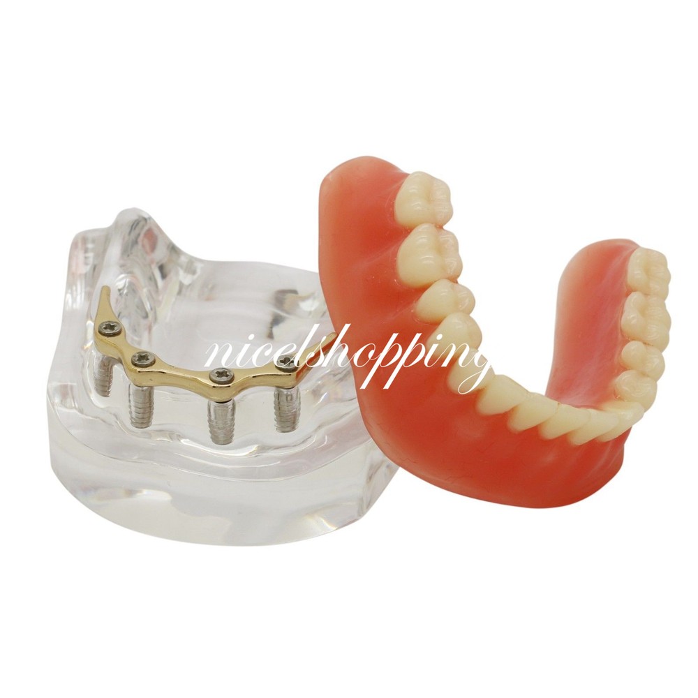 Dental Inferior Overdenture Model Lower Precision Implants With Silver Bar #6009