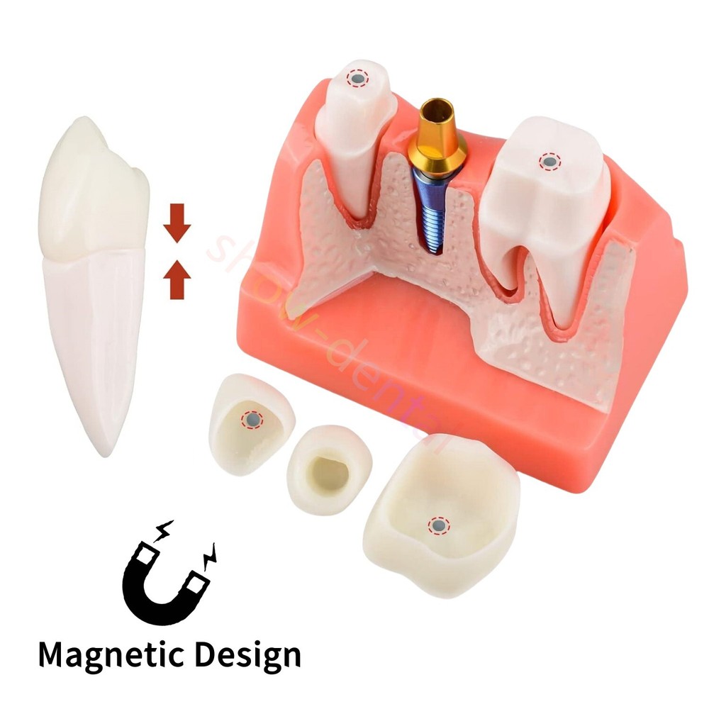 Dental Implant Analysis Removable Crown Teeth Model Analysis Study Model