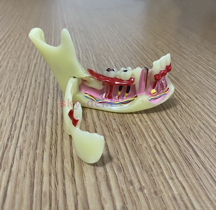 Dental Typodont Teeth Model Ortho Implant Pathological Perio Practice Demo Model