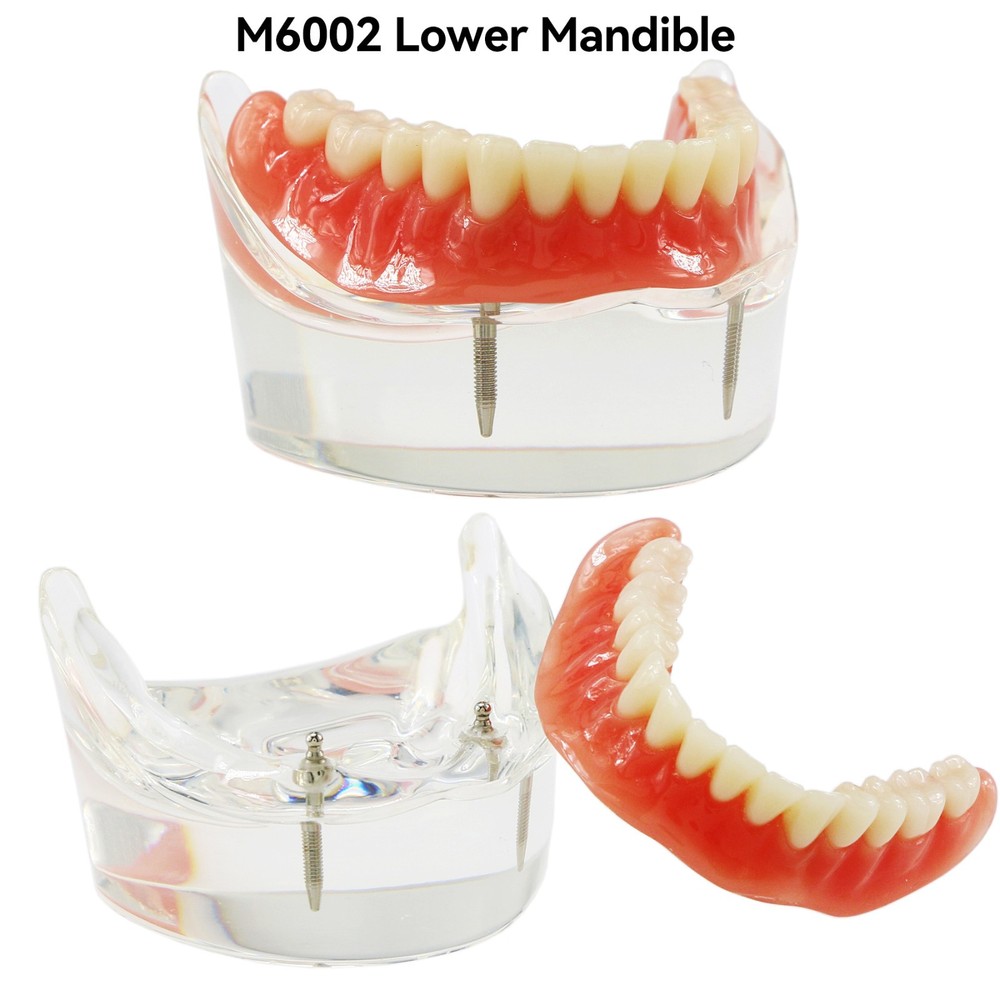 Implant Restoration Teeth Model Mandibular Overdenture with 2 Implants Dental