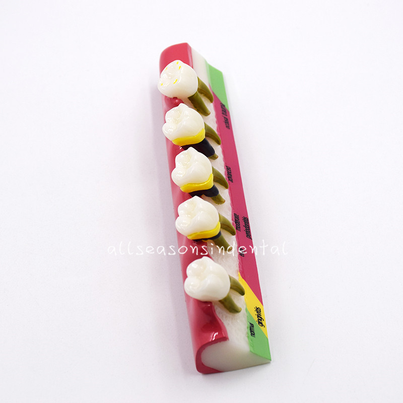 Dental Study Teaching Model Periodontal Disease Assort Teeth Dentoform Typodont