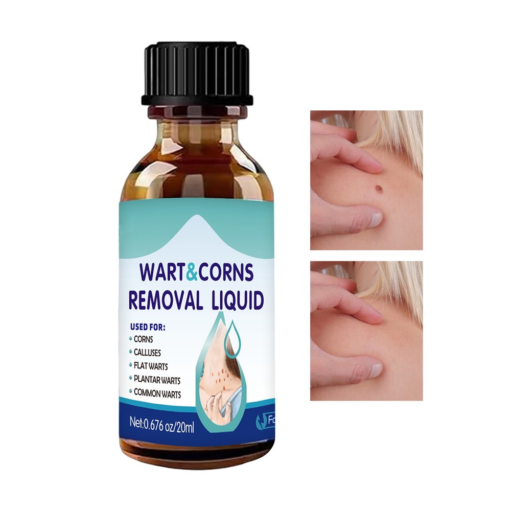 Skin Mole Remover For Body 20ml Blemish Solution Skin Mole Removal Liquid