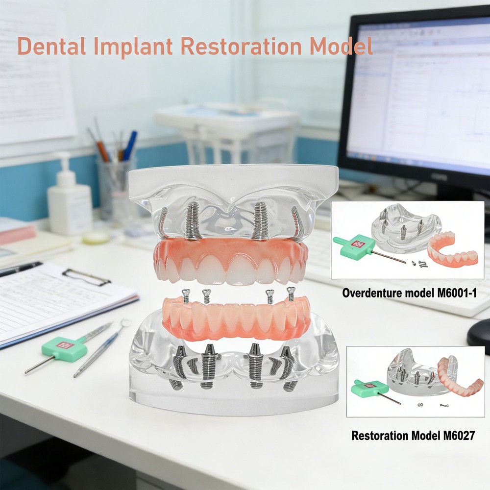Dental Upper/Lower 4 Implants Demo Implant Teeth Model Restoration Overdenture U
