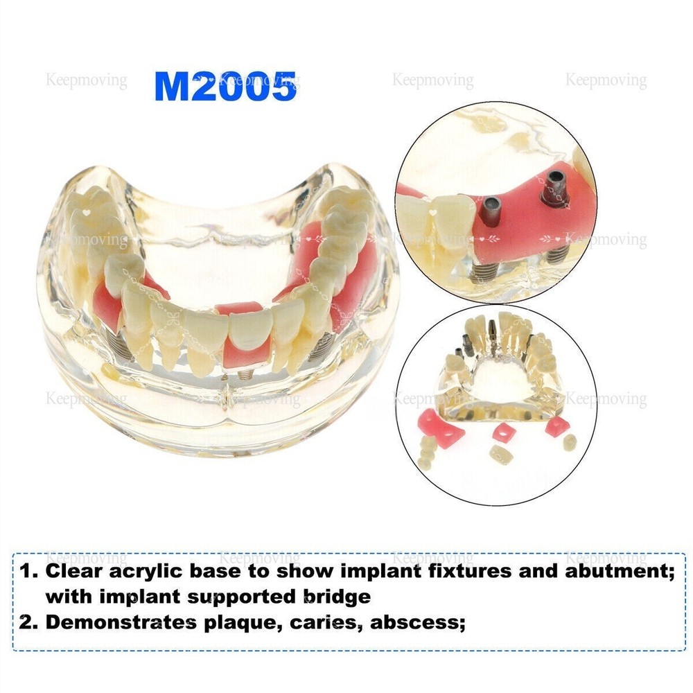Teeth Model Dental Typodont Ortho Implant Pathological Perio Practice Demo Model