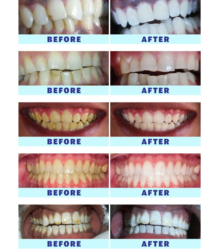 blanqueador de dientes. gel blanqueador de dientes