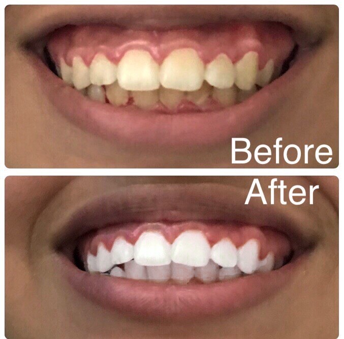 Teeth Whitening tooth Smart phone LED bright Light for iPhone, Android, USB