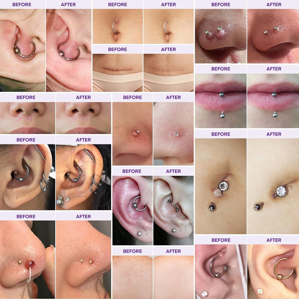 Piercing Keloid Bump Solution Kit | Aftercare Treatment with...