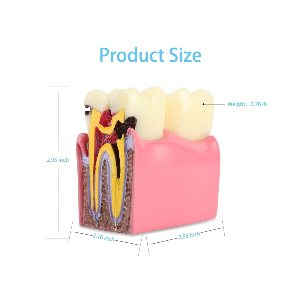 Dental Caries Tooth Model 6 Times Decay Teeth Comparative Study Model, Caries...