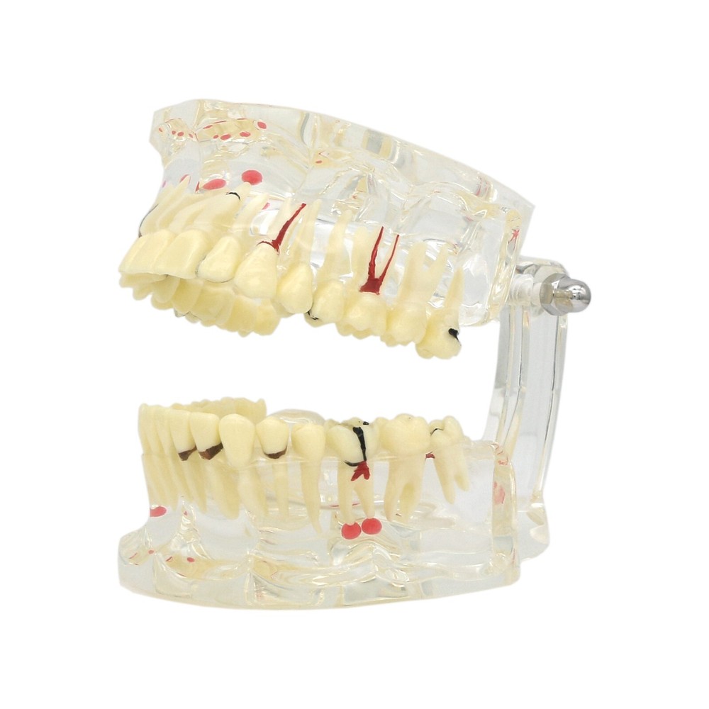 Dental Typodont Teeth Model Pathological Perio Implant Endo Caries Teeth Model