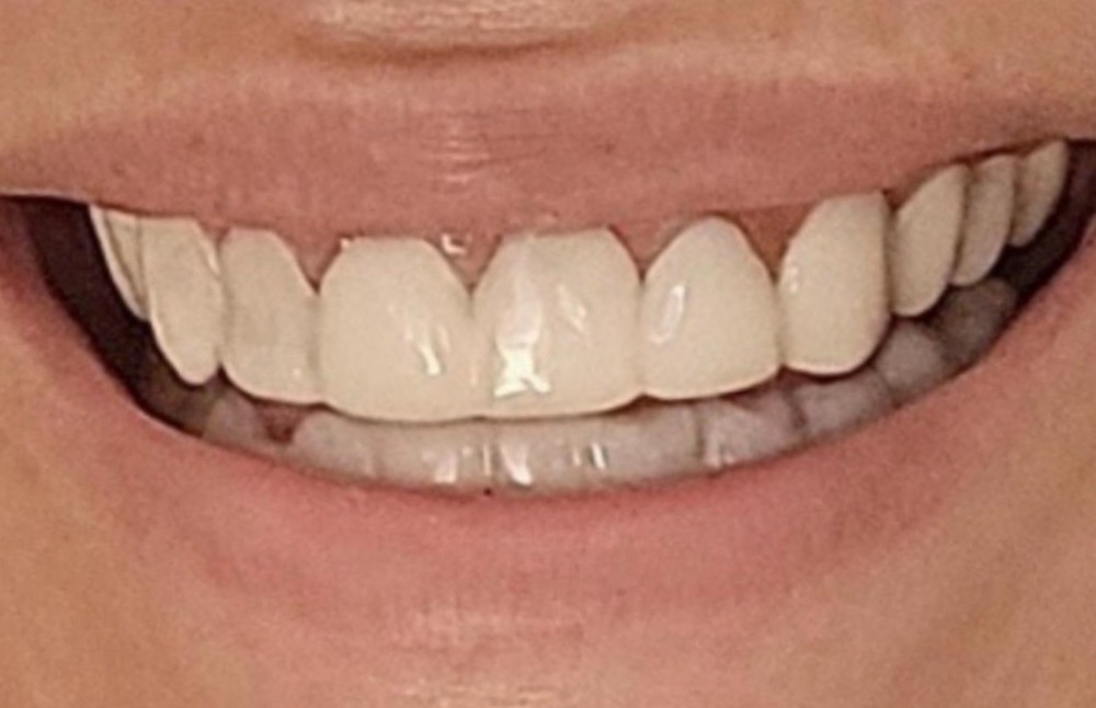 Custom Upper or Lower Cosmetic Click on Veneer