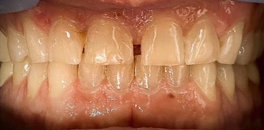 Custom Upper or Lower Cosmetic Click on Veneer