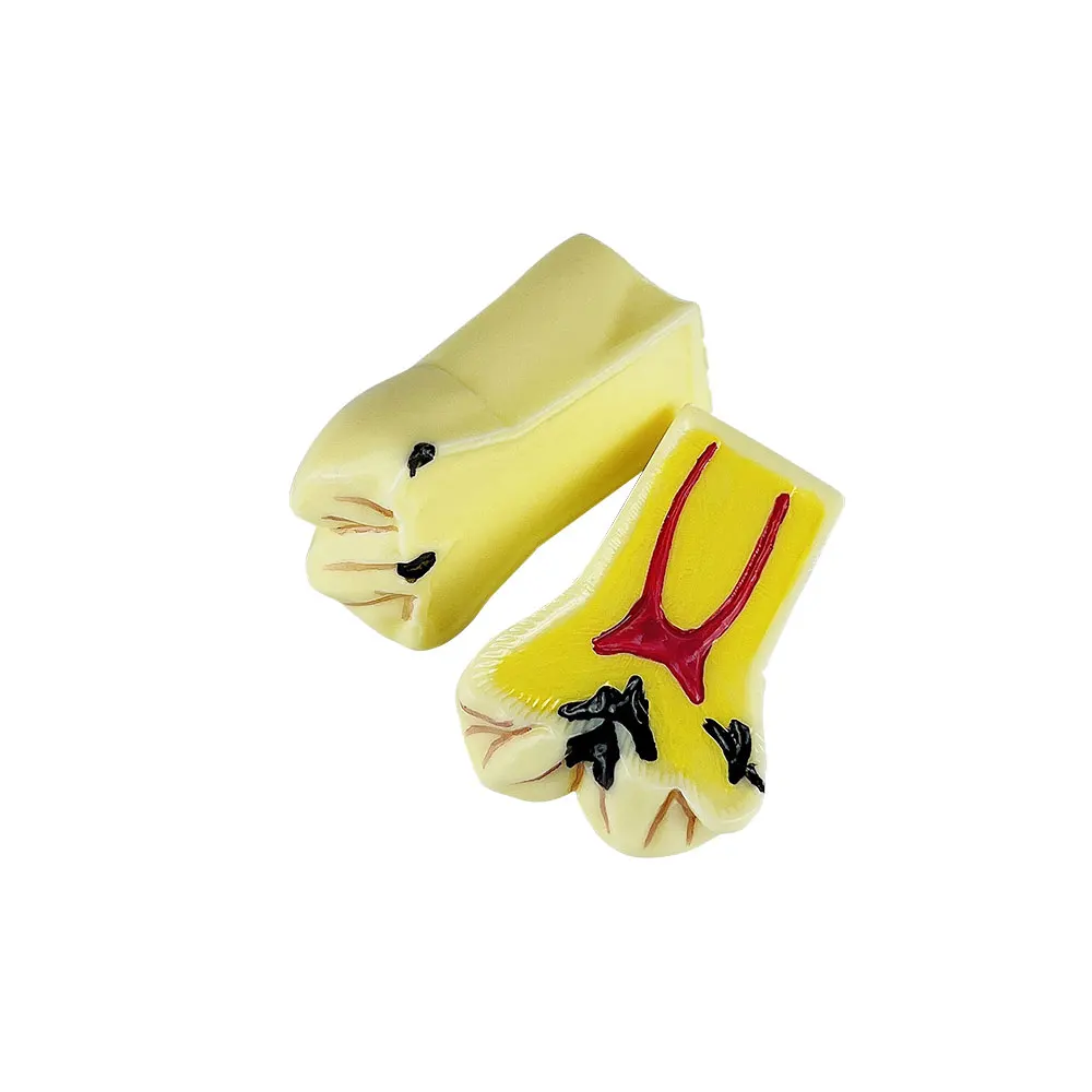 Dental 4 Times Caries Evolution Model Tooth Decay Comparsion Demonstration Model
