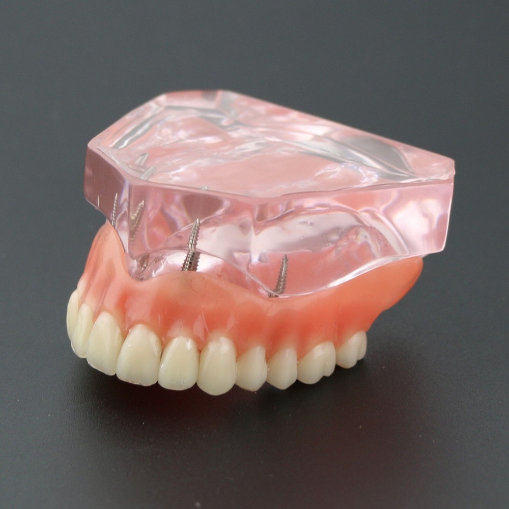 Dental Teeth Model Demo Overdenture Restoration With 4 Implants Upper Maxillary