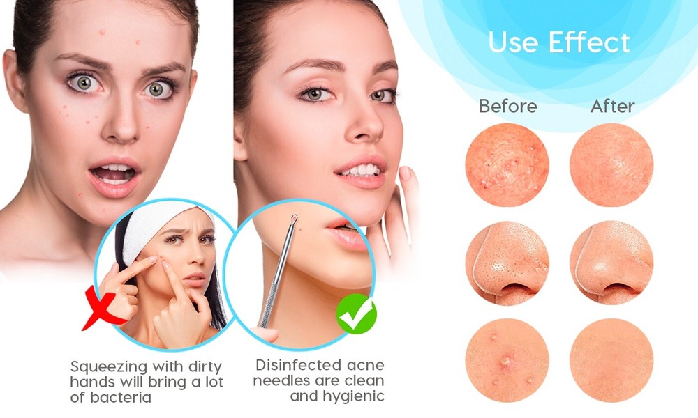 InstaSkincare Blackhead and Blemish Remover Tool Kit