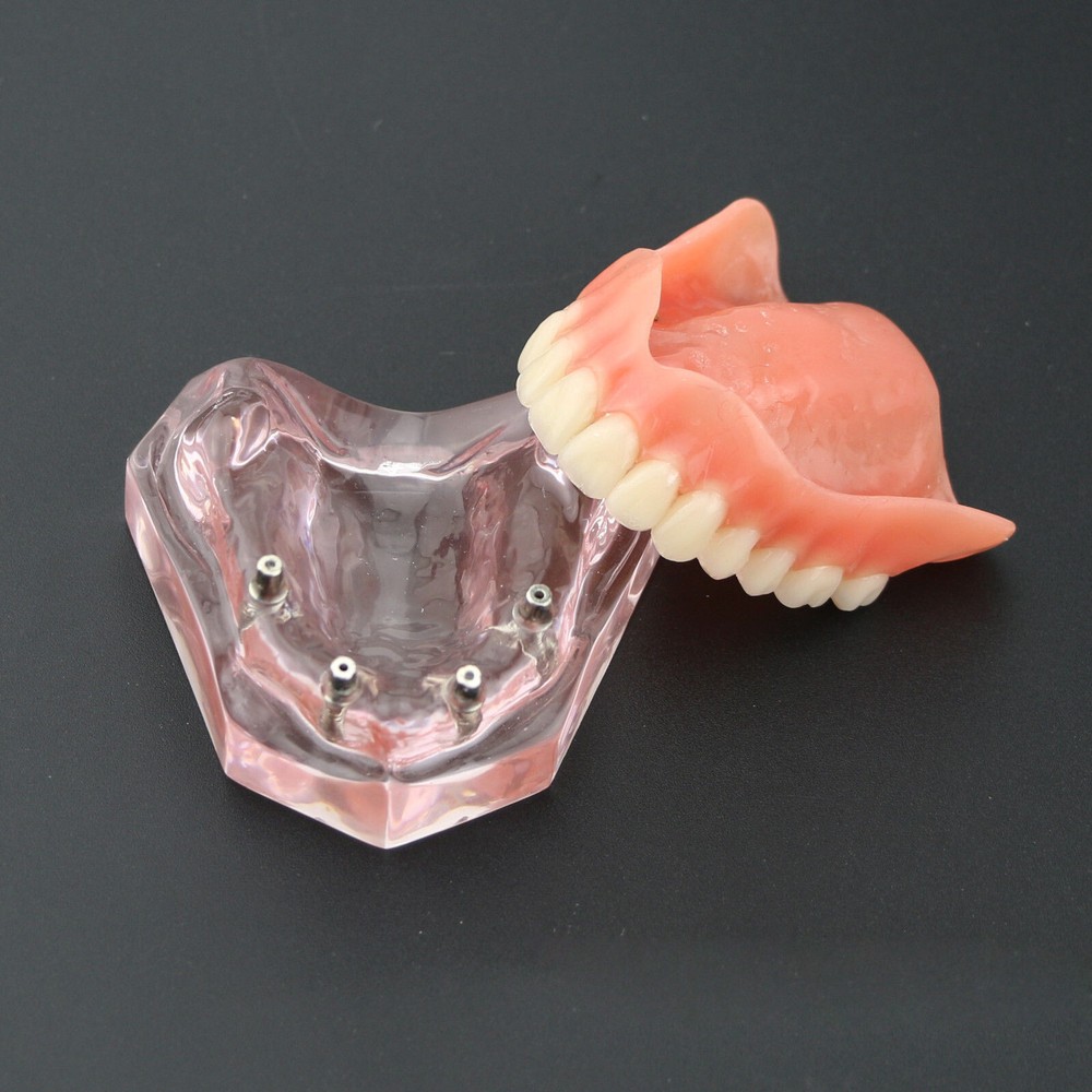 Dental Teeth Model Demo Overdenture Restoration With 4 Implants Upper Maxillary