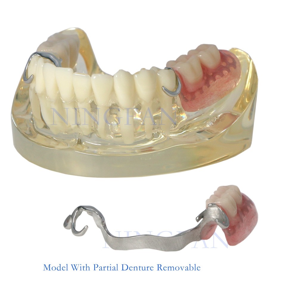 Dental Implant RPD Restoration Model Removable Partial Denture Lower 2 Implants