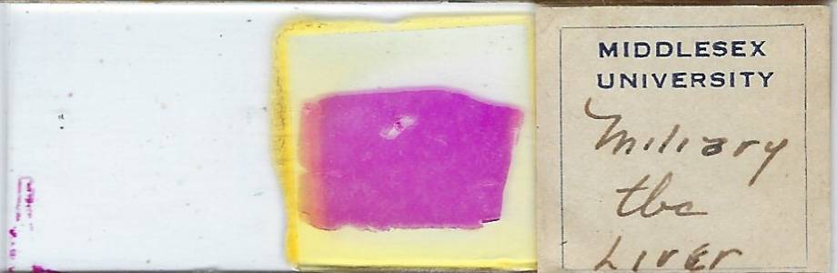 Human Miliary Tuberculosis Liver Pathology Microscope Slide
