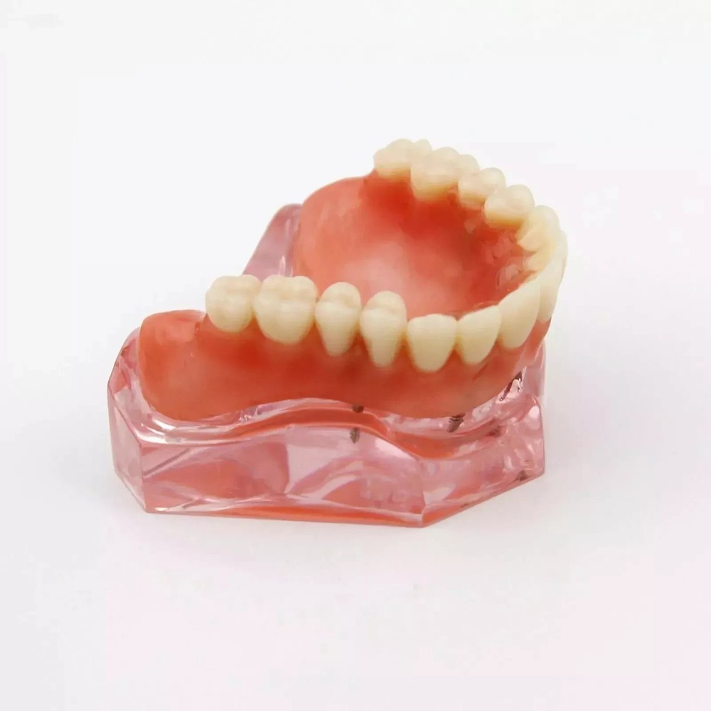 7 Types Dental Overdenture Restoration Model Implants Typodont Teaching Study