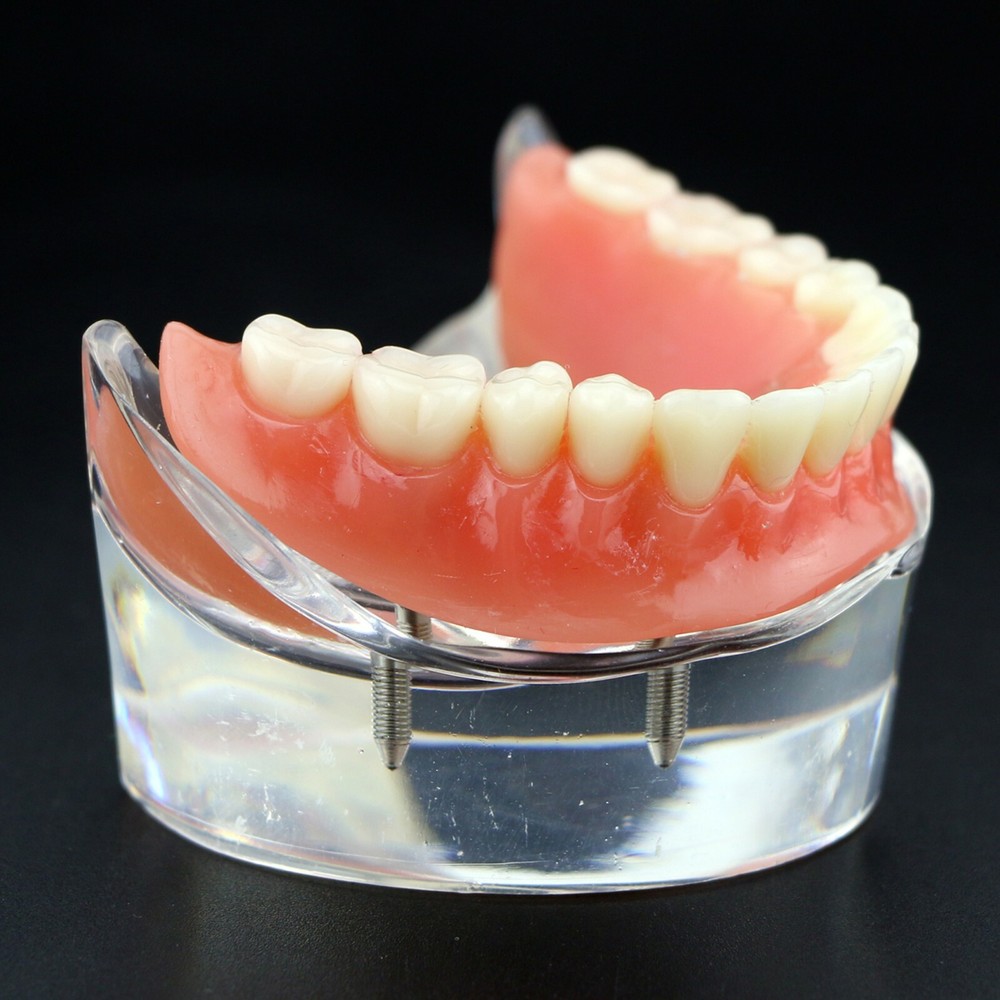 Dental Implants Model Demo Overdenture Typodont Teeth Superior Anatomical model