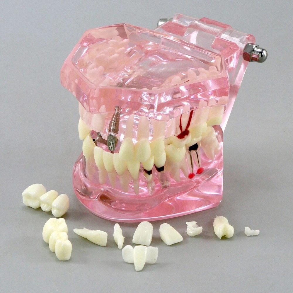 Dental Teeth Model Multiple Types Ortho Implant Practice Teaching Demo Model