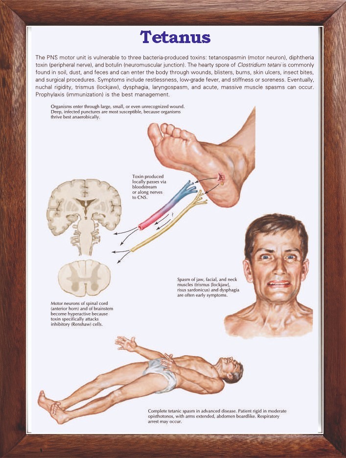 Tetanus Chart 12x18 inches