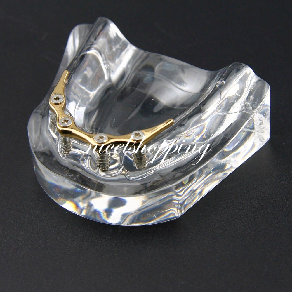 Dental Inferior Overdenture Model Lower Precision Implants With Silver Bar #6009