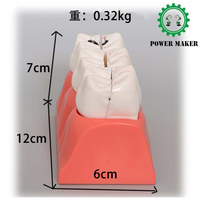 3 Stage Dental Caries Development Model Dental Model Caries Disintegration Model