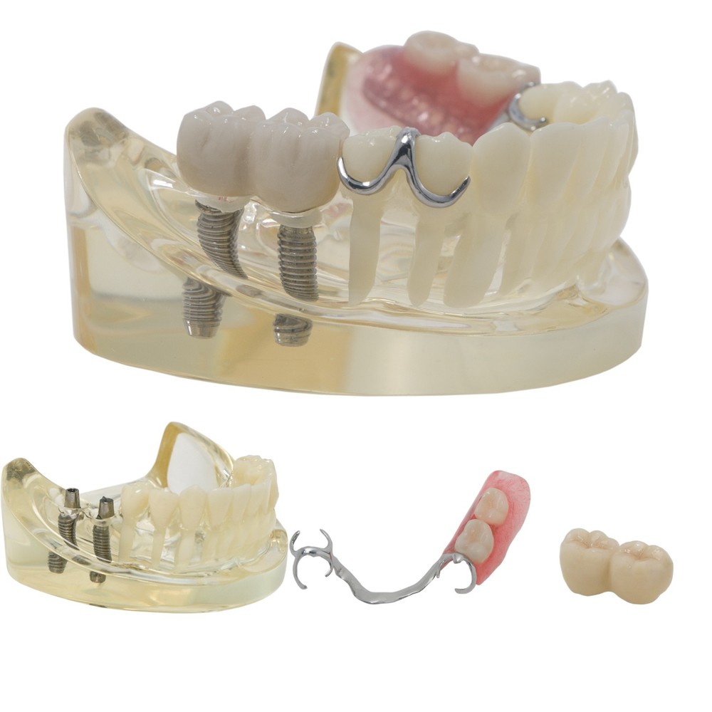 Dental Implant RPD Restoration Model Removable Partial Denture Lower 2 Implants