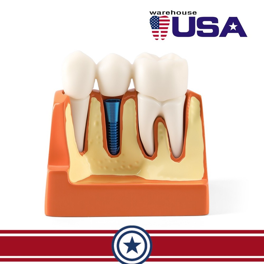 4 Times Dental Teeth Model Implant Crown Bridge Removable Study Teaching Tool