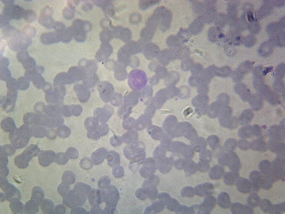 Balantidium Coli Trophozoites; Smear