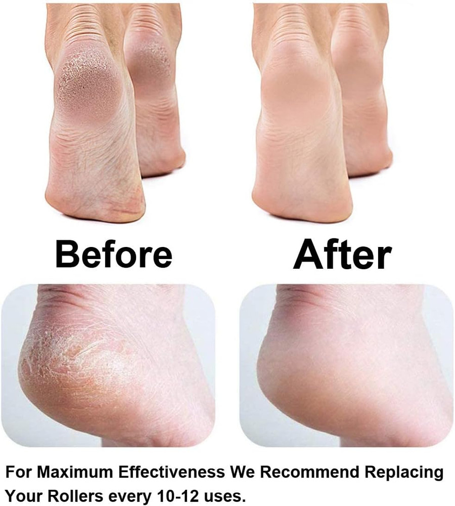 Roller Compatible with Dr. Scholl'S Remover Electronic Foot File-Extra Coarse...