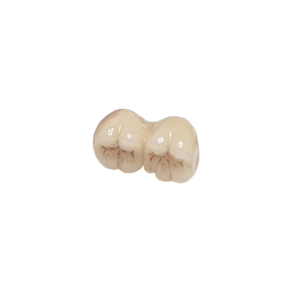 Dental Training Typodont Model with Removable Partial Denture Teaching Model