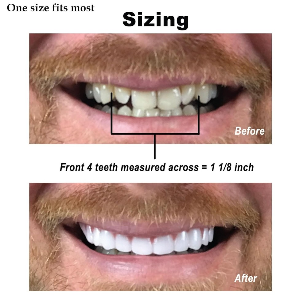 Comfort Fit Flex Dental Veneers